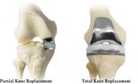 Low Cost Total Knee replacement Surgery in India image 8